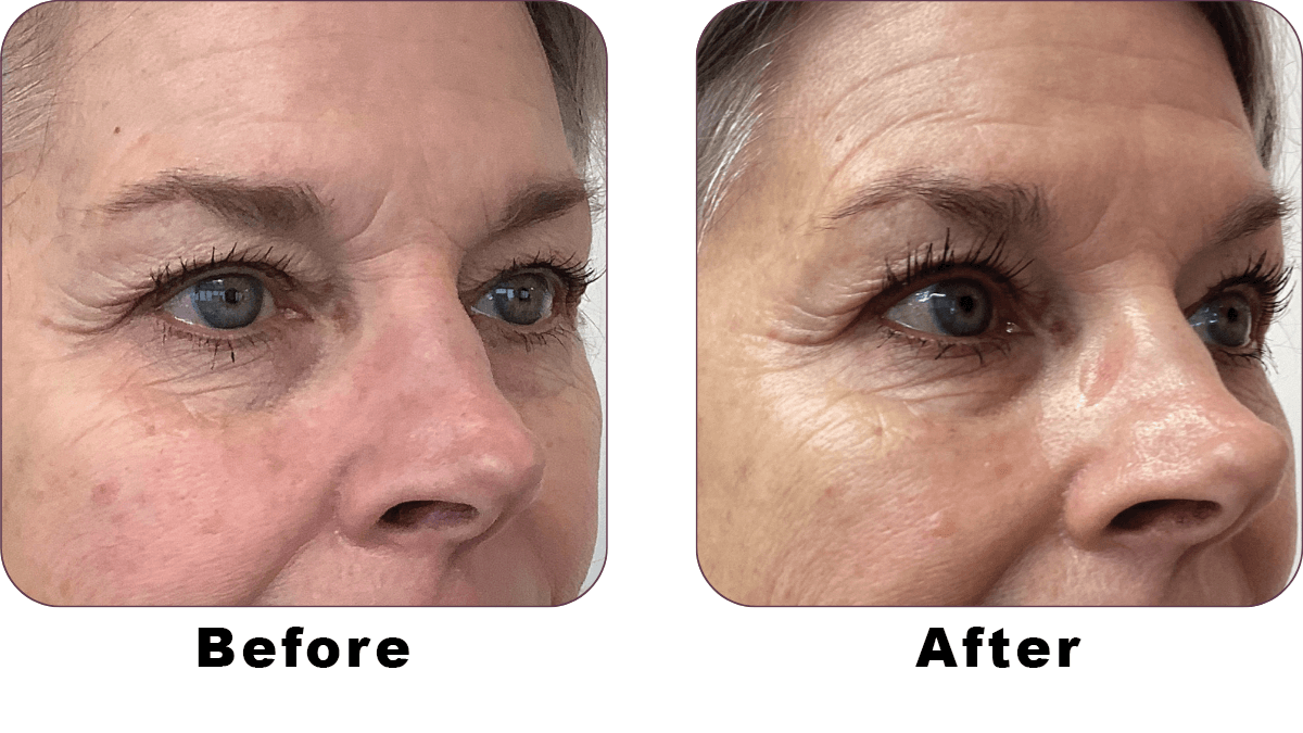 THERMAGE BEFORE AND AFTER